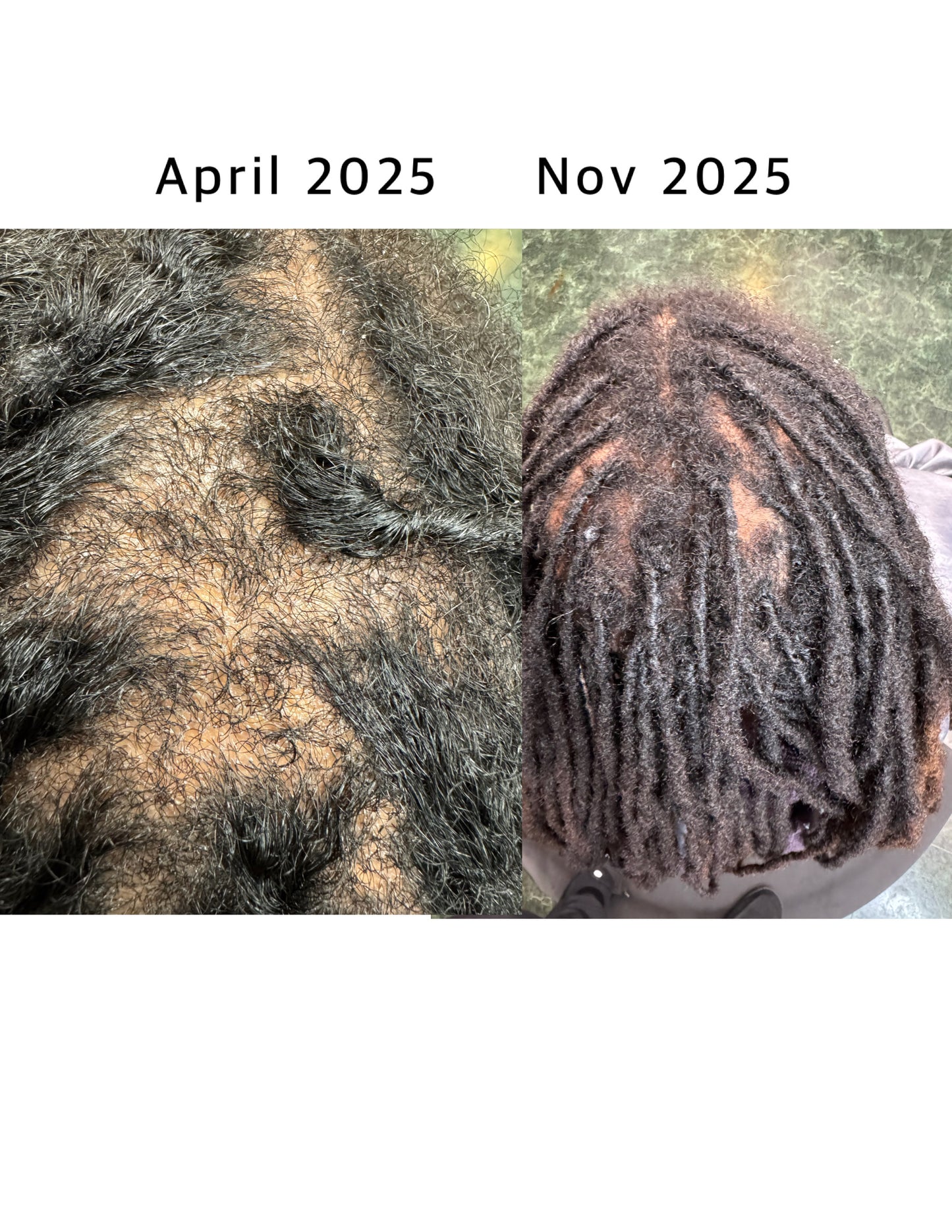 SVN Hair Growth Serum