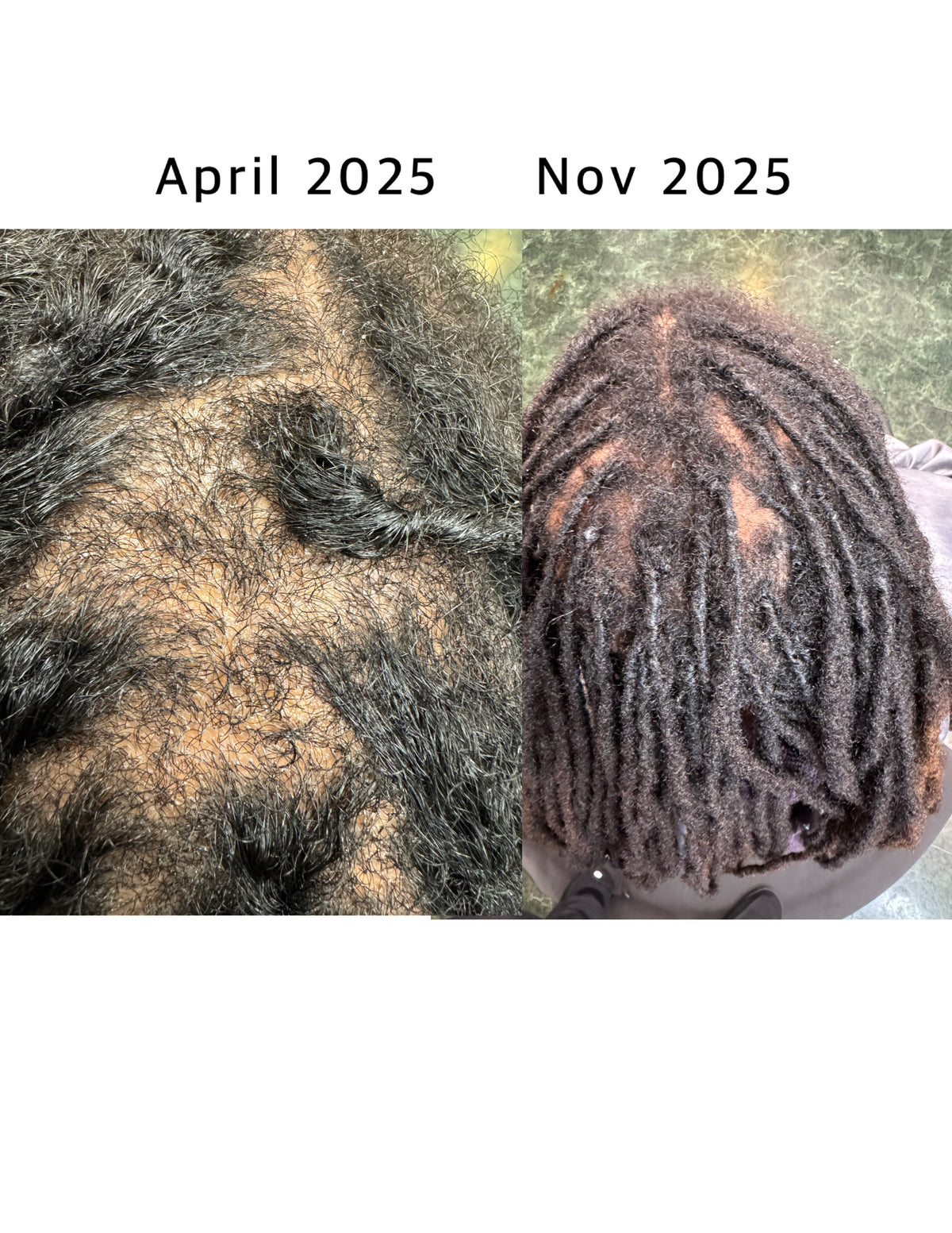 SVN Hair Growth Serum